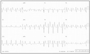 Figure 4  Hyperkalemia causing a WCT in a patient with chronic renal failure (K+ 9.1). The patient’s heart rate is 108 bpm, the QRS duration is 134 msec. Note the prominent, narrow peaked T waves (esp. V2, V3), which, with historical factors, should help identify this diagnosis.