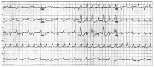 Figure 5b 12-lead ECG from a different patient demonstrating bidirectional ventricular tachycardia from digitalis toxicity. The axes of the RBBB-morphology QRS complexes alternate.