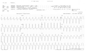 Figure 6 Example of an unusual WCT known as Idiopathic (benign) Ventricular Tachycardia. This is caused by a re-entry loop in the apex of the LV, resulting in the left superior axis and RBBB pattern. Also called Left Ventricular Tachycardia, it often responds to Verapamil. (Note -- CCBs should not be used in WCTs unless recommended by a cardiologist or electrophysiologist.)