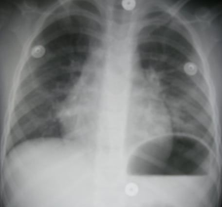 Chemical Pneumonitis from Hydrocarbon Aspiration