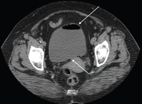 A Case of Complicated Urinary Tract Infection: Klebsiella pneumoniae Emphysematous Cystitis Presenting as Abdominal Pain in the Emergency Department