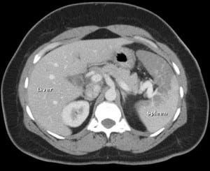 Figure 1 Contrast abdominal CT at the level of the splenic hilum shows lack of contrast enhancement in a large area of the anterior spleen.