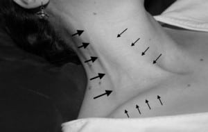 Figure 1 The surface anatomy of the external jugular vein, (indicated by the large arrows). The clavicle and sternocleidomastoid muscle are indicated by the small arrows.