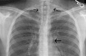 Figure 2 PA CXR showing pneumopericardium and free air in cervical soft tissues