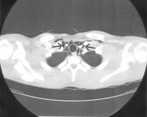 Figure 3 CT upper thorax with pneumomediastinum