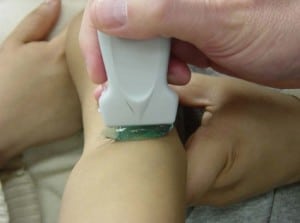 Figure 2 The static “ no touch” technique. Note the thick ridge of acoustic gel between the transducer and the patient’s skin. The thick layer of gel improves vessel visualization and ensures that the target vein will not be inadvertently compressed.