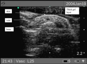 Figure 3 Ultrasound image of target vessel