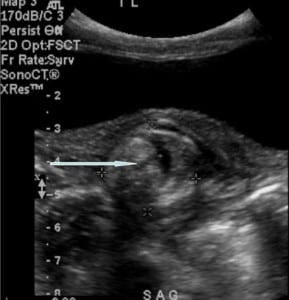 Figure 1 Limited pelvic ultrasound demonstrating a rounded mass in the left lower pelvis (arrow and crosses)