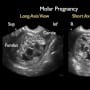 Ultrasound Detection of a Molar Pregnancy in the Emergency Department
