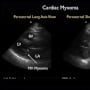 Ultrasound Diagnosis of a Left Atrial Myxoma in the Emergency Department