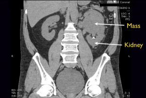 Figure. Coronal computed tomography showing renal carcinoma.