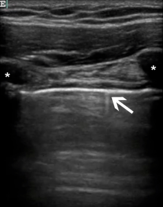 Figure 1. Ultrasound image of a normal lung shows the parietal pleura (arrow) and ribs (asterisks).