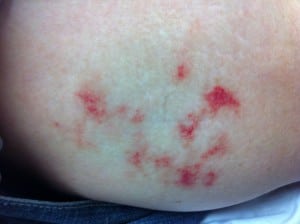 Figure 2. Early skin lesions on right thigh. 