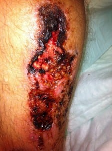 Figure 3. Late-stage skin ulceration to left leg with necrotic borders.