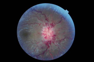 Figure 1: Fundoscopic examination of the right eye. 