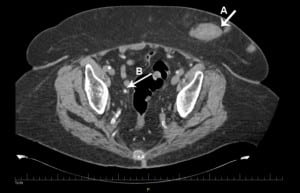 Figure. Computed tomography of the abdomen and pelvis without contrast showing multiple soft tissue densities in the anterior abdominal wall (A). Calcification of blood vessels within the abdomen and pelvis was also noted (B).