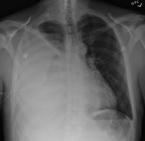 Figure 1. Chest radiograph PA view showing opacification of the right hemithorax. 