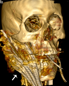 Figure. The cable entered the right mandible at the level of the angle of the mandible and superiorly near the condyle, terminating 3 cm into the right temporal lobe.