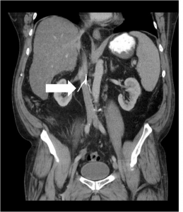 Figure 1. Coronal view of a inferior vena cava (IVC) filter with strut visible outside the IVC.