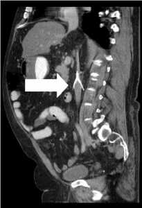 Figure 2. Sagittal view of a inferior vena cava (IVC) filter with strut visible outside the IVC.