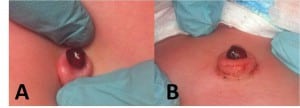 Figure. View from above (A) and from the side (B) with umbilicus retracted to demonstrate pedunculated stump of the umbilical granuloma.