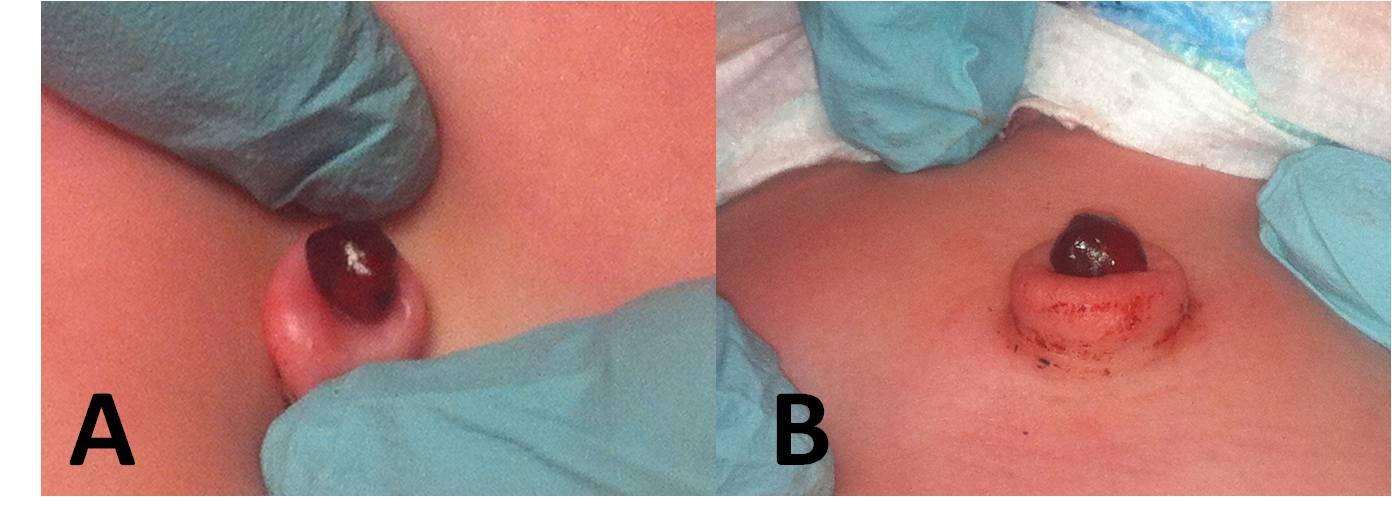 Neonatal Umbilical Mass