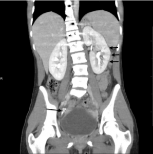 Figure Intravenous-contrast enhanced computed tomography of the abdomen and pelvis. Three short arrows illustrate residual contrast in the parenchyma of the left kidney. This is a striated nephrogram and is consitent with acute pyelonephritis. The long arrow shows several appendicoliths in a dilated appendix. This is consistent with acute appendicitis.