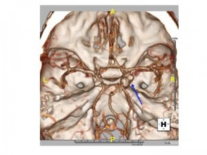 Figure 3. Computed tomography angiography of the brain illustrating homogeneous enhancement of a 1.1 × 0.8 × 0.8 cm bilobed, saccular aneurysm (blue arrow) in the region of the right posterior communicating artery.