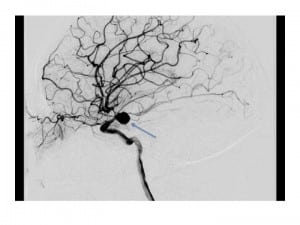 Figure 4. Cerebral angiography of the patient’s vasculature demonstrating the right posterior communicating artery aneurysm in lateral view (blue arrow).