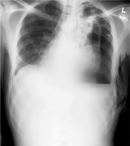 Figure 1. Chest radiograph after tube thoracostomy of a 32-yearold male with shortness of breath, with improvement in respiratory status and lung expansion with persistent left-sided air-fluid level and pneumothorax. (All patient images taken with permission of patient or accompanying guardian.)
