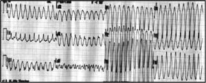 Figure 4. Electrocardiogram of a 56-year-old previously healthy man with chest pain and shortness of breath that started while he was jogging.