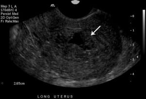 Figure 1. Ultrasonography of uterus in long axis showing enlarged endometrial cavity (2.65 cm) with irregular clot.