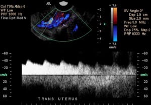 Figure 2. Ultrasonography of uterus in transverse axis with color doppler flow showing pulsatile flow inside the endometrial cavity.