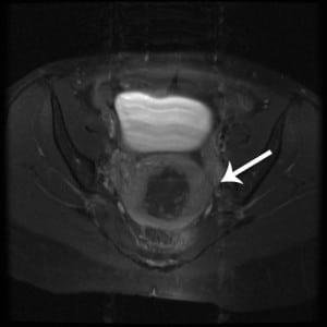Figure 3. Magnetic resonance imaging of uterus in transverse axis demonstrating amorphous collection of vessels with fluid in the endometrial cavity.