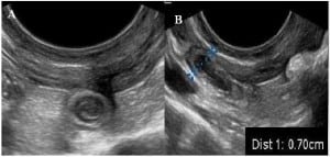 Figure 1. Transvaginal imaging of the right adnexa. (A) Transverse view of the appendix. (B) Long view of the appendix measuring 0.7 cm.