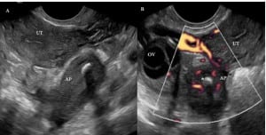 Figure 2. Transvaginal imaging of the right adnexa demonstrating appendicitis. (A) Enlarged appendix (AP) with appendicolith (*). The uterus (UT) is also seen. (B) Hyperemic appendix (AP) visualized in transverse, appendicolith (*), right ovary (OV), and uterus (UT) seen.