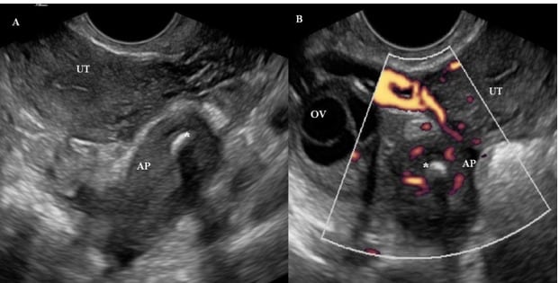 Appendicitis Diagnosed by Emergency Physician Performed Point-of-Care Transvaginal Ultrasound: Case Series