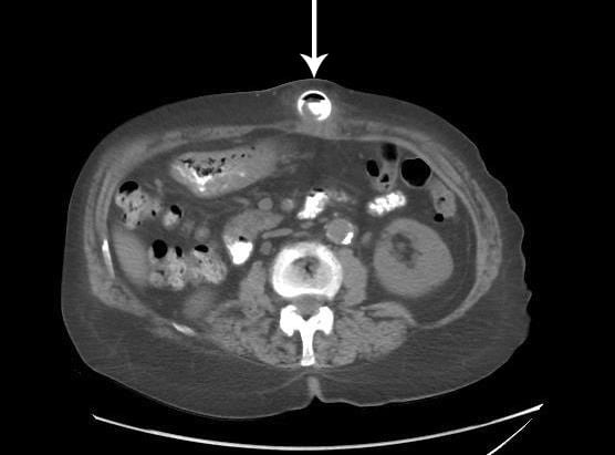 Early Presentation of Buried Bumper Syndrome