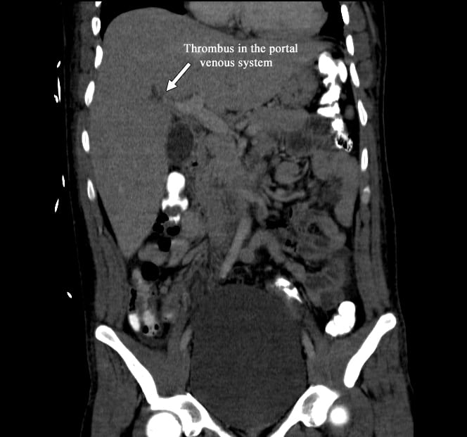 Pylephlebitis in a Previously Healthy Emergency Department Patient with Appendicitis