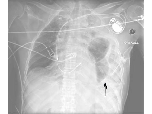 Diaphragmatic Rupture Secondary to Blunt Thoracic Trauma