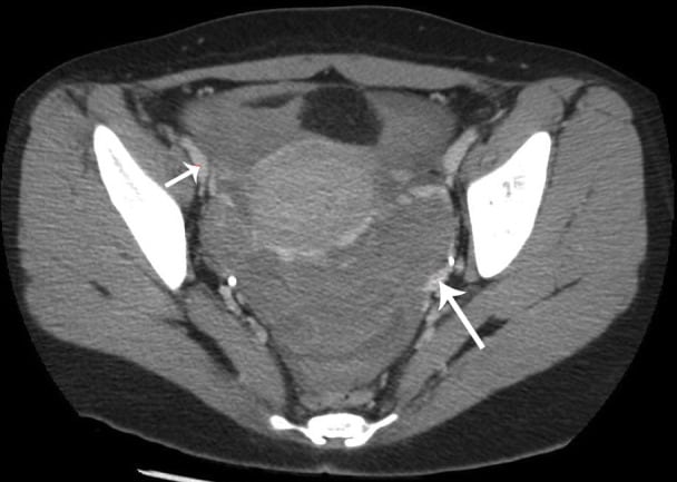 Uterine Rupture Due to Invasive Metastatic Gestational Trophoblastic Neoplasm