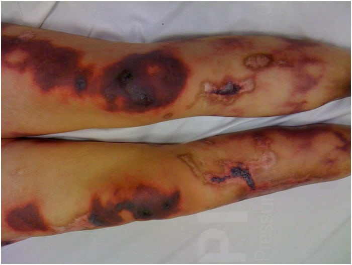 Levamisole Contaminated Cocaine Induced Cutaneous Vasculitis Syndrome