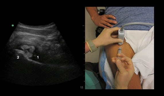 Ultrasoundguided Intraarticular Hip Injection for