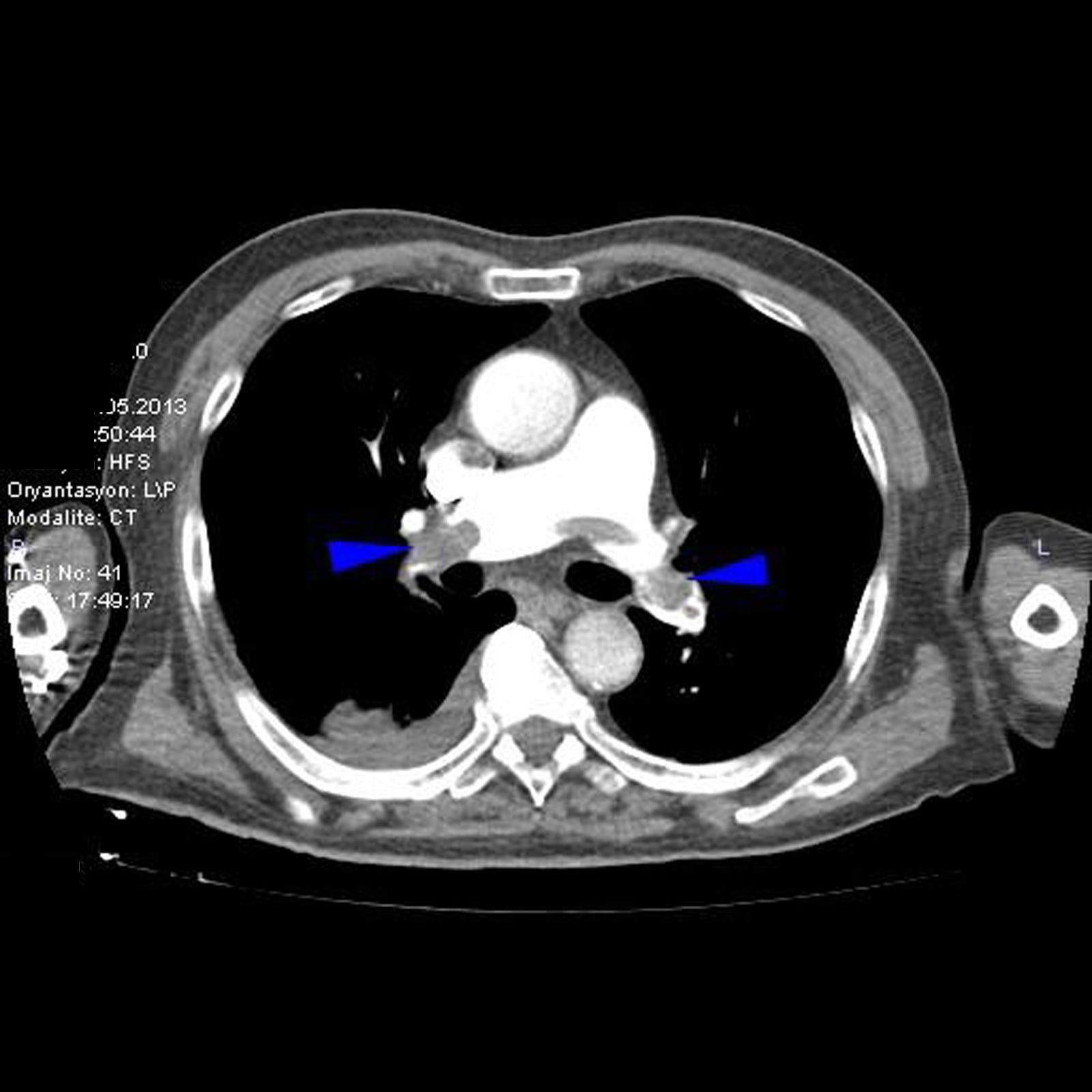 Visualization of Cardiac Thrombus by Bedside Ultrasound