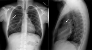Figure 1. Anterior-Posterior chest radiograph on index visit showing a 1.3 cm right upper lobe density (arrows).