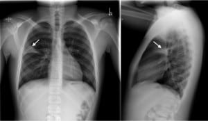 Figure 2. Anterior-Posterior chest radiograph on day 6 showing consolidation of the inferior segment of the right upper lobe (arrows).