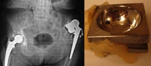 Figure. Bilateral hip prosthetization with dislocation of both prosthetic components of the left hip. This is a Brunelli THR version, peculiar for the squared and cemented socket. On the right is visible a color photo of an explanted cup. The cemented socket is rotated and the cemented straight stem is loosened. Surgical approach used was the Watson-Jones (wire cerclage is visible around greater trochanter).