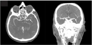 Figure 1 Transverse (left) and coronal (right) computed tomography angiogram demonstrating abrupt cutoff of the left middle cerebral artery at the site of the thrombus (marked by arrows).