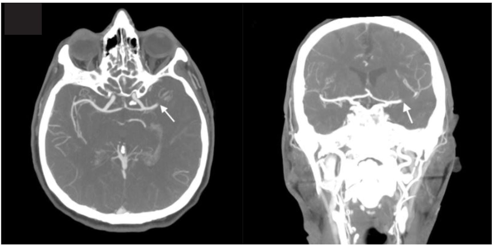 Usefulness of Computed Tomography Perfusion in Treatment of an Acute Stroke Patient with Unknown Time of Symptom Onset