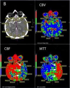Figure 2. Computer-generated perfusion map demonstrating the region of the left cerebral hemisphere (CBF) with decreased cerebral blood flow and prolonged mean transit time (MTT) (marked by arrows). Note that this region of the brain has normal cerebral blood volume (CBV) indicating potentially salvageable brain tissue.